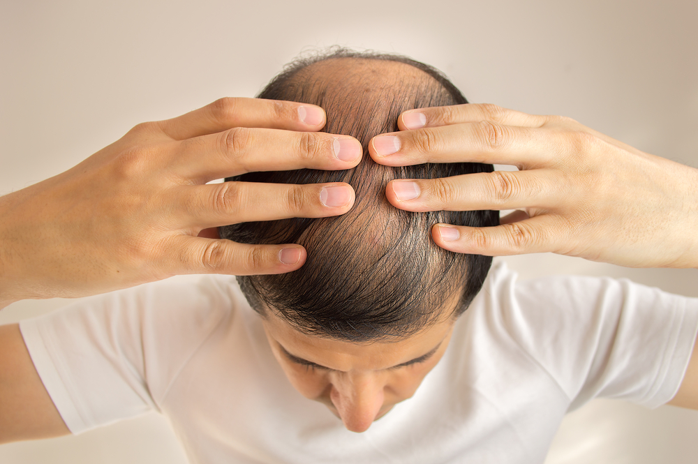 chute de cheveux